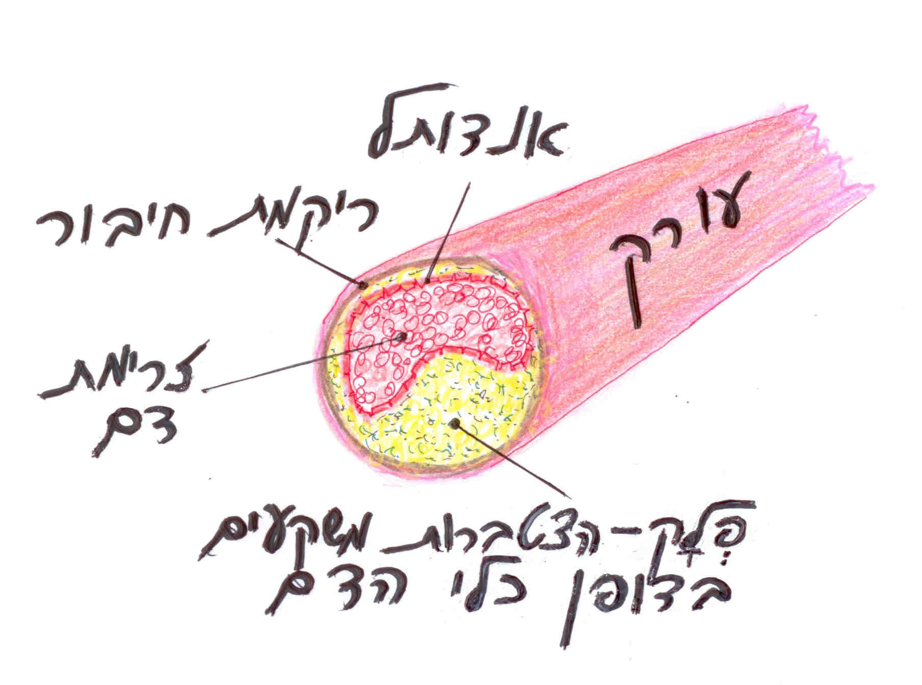 מראה עורק סתום במצב של "טרשת עורקים"